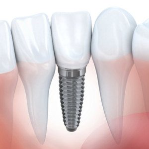 vancouver implant dentist